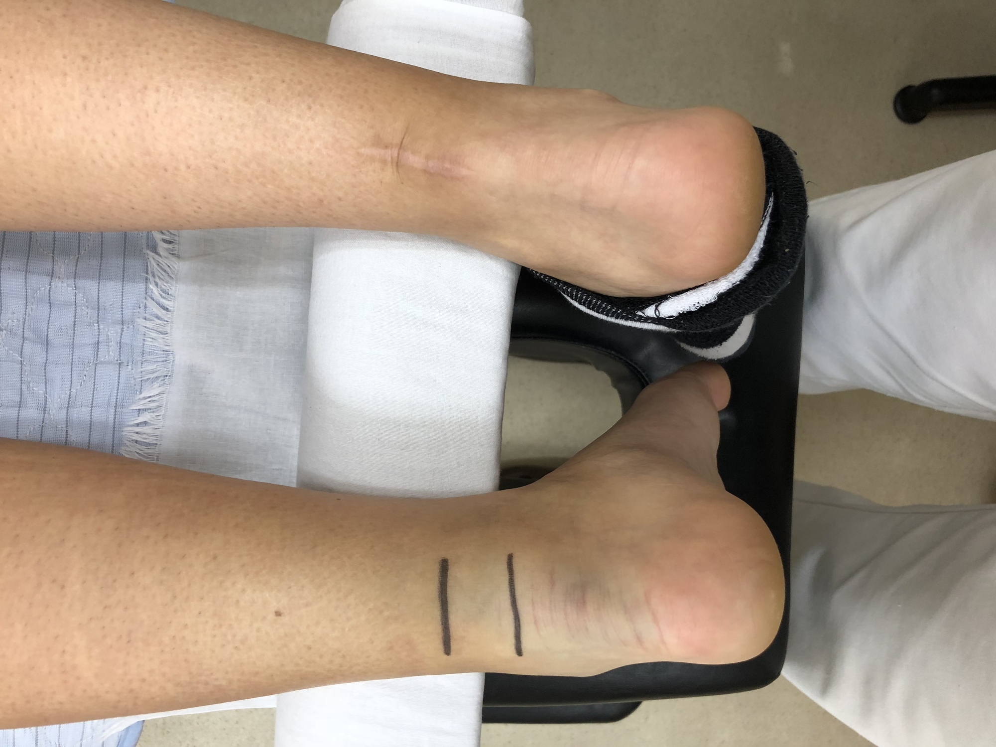 アキレス腱断裂の原因